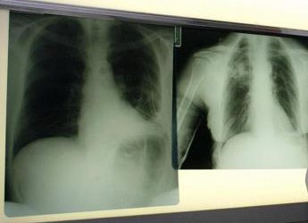 Tumori, cancro del polmone in stadio precoce: con nuova terapia 88% pazienti vivo a 5 anni