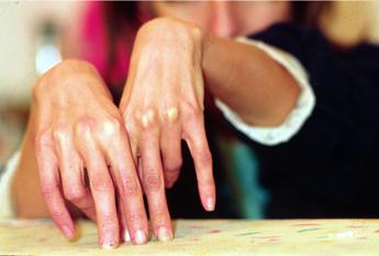 ‘Disturbi alimentari stanno diventando incurabili per scelta politica’, lo sfogo