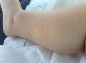 Salute: orticaria cronica spontanea, da esperti guida utile per medico e paziente