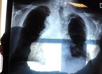 Tumori, Pastorino (Int): “Screening polmonare nei Lea per prevenzione globale”