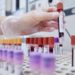 Tumori, cellule Carcik efficaci contro leucemia, studio italiano su 27 pazienti