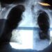 Bpco, pneumologa Foschino Barbaro: “Nella donna sintomi diversi, attenzione alle giovani”