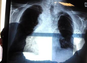 Cancro ai polmoni, individuato il punto debole: è nel ‘motore’ che lo fa crescere
