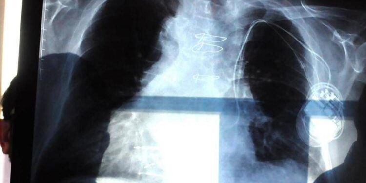 Cancro al polmone aggressivo, combinazione farmaci riduce del 58% rischio morte