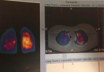 Long Covid, la storia di Marta: “Sto male da 3 anni. In tanti lottiamo per riprendere vita e lavoro”