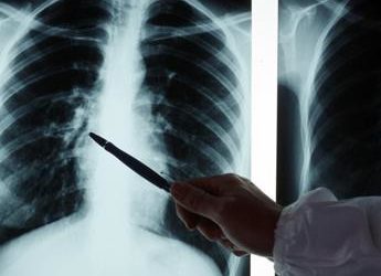 “Tubercolosi in ripresa, ricomincia a fare paura”