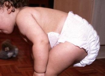 Esperti, ‘Sos pannolini in estate, con caldo e mare raddoppiano dermatiti’