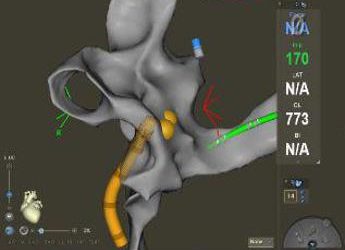 Ospedale Mauriziano di Torino, per la prima volta al mondo ablazione fibrillazione atriale senza raggi X
