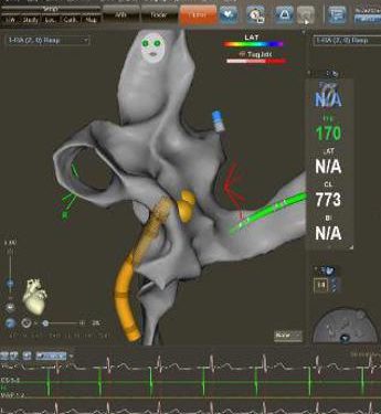 Ospedale Mauriziano di Torino, per la prima volta al mondo ablazione fibrillazione atriale senza raggi X