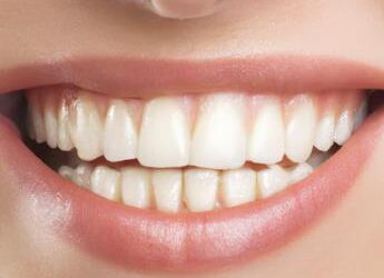 Sorriso ‘social’ perfetto e subito, è boom per le faccette sui denti anche a 14 anni