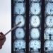 Calcio e ripetute commozioni cerebrali, neurologa: “Rischi a lungo termine”