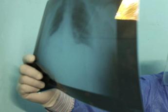 Ipertensione arteriosa polmonare, risultati promettenti per nuova molecola Msd