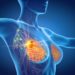 Cancro seno metastatico per 37mila italiane, Aiom: “Biopsia liquida cruciale”