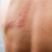 Dardani (Sir): “Herpes Zoster più rischioso per pazienti reumatologici”