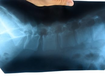 Ucb, dati positivi bimekizumab a 5 anni contro spondilite anchilosante