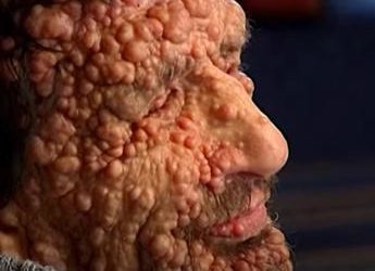 Neurofibromatosi, il morbo che deturpa il volto: ecco la malattia che ha commosso il Papa