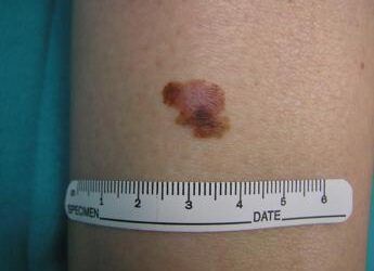 Cancro, oncologo: “Tre anni per vaccino mRna contro melanoma”