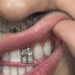 Gioielli sui denti, è grillz mania: possibili rischi