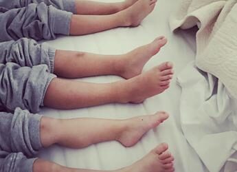 Dal ginocchio valgo al piede piatto, i difetti nei bimbi: cosa fare e quando preoccuparsi
