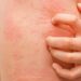 Fake news sull’orticaria, l’immunologo: “Diffidare dai test farlocchi”