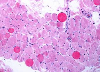 Distrofia Duchenne, via italiana per riparare e rigenerare i muscoli