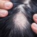 Alopecia areata, ok Aifa a rimborsabilità nuovo trattamento