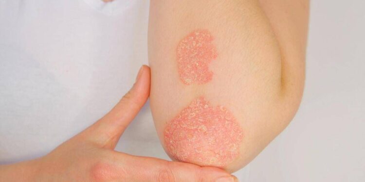 Giornata psoriasi, Ucb rinnova l’impegno contro lo stigma