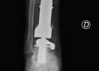 Chirurgia, la gamba bionica di Mario salvata da una protesi di caviglia su misura