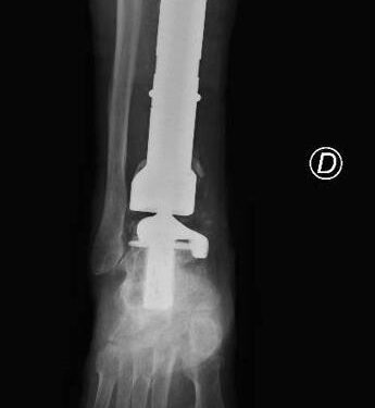 Chirurgia, la gamba bionica di Mario salvata da una protesi di caviglia su misura