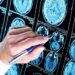 Sogni scudo anti-Alzheimer? Ritardo sonno Rem possibile spia precoce malattia