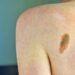 Melanoma, Ascierto (Scito): “Con immunoterapia più speranze per metà forme gravi”