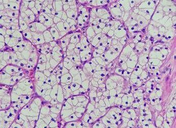 Studio, Tki e immunoterapia più efficace di sunitinib in carcinoma a cellule renali