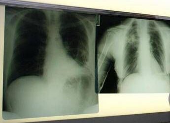 Cancro polmone a piccole cellule, ok Ue a tislelizumab