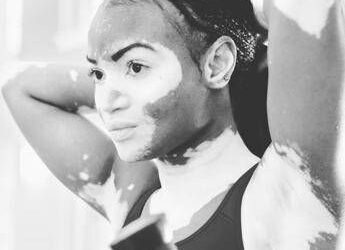 Giornata della vitiligine contro stigma e falsi miti, un ‘doppio attacco’ può batterla