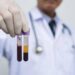 Ricerca, allo studio analisi sangue a casa e test cerebrali online per scoprire rischio demenza