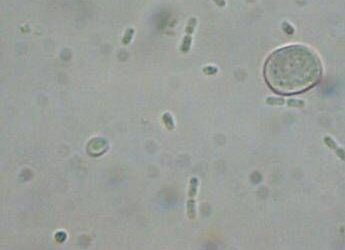 Batterio mangiacarne uccide 4 persone, Bassetti: “Colpa del clima”