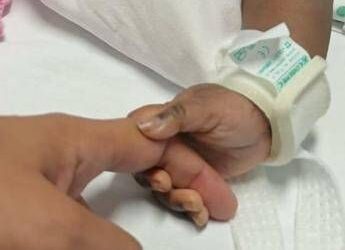 Gemelle siamesi separate al Gaslini di Genova: “Estubate, respirano da sole”