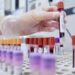 Sclerosi multipla recidivante, Ema raccomanda approvazione ocrelizumab dai 10 anni