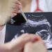 Chirurgia, si rompe l’aorta e viene operata con il bimbo in utero, intervento record a Milano