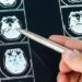 Ecco come il Long Covid cambia il cervello con meccanismi tipici dell’Alzheimer