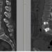 Chirurgia vertebrale complessa, al Tiberia Hospital di Roma intervento con tecnica Alif