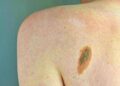 Ogni anno in Italia 2.600 casi ereditari di melanoma, Imi:”Prevenzione con test genetici e controlli”