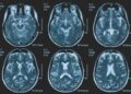 Una persona su 3 ha un disturbo neurologico, a Napoli arriva BrainSpace House