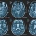 Una persona su 3 ha un disturbo neurologico, a Napoli arriva BrainSpace House