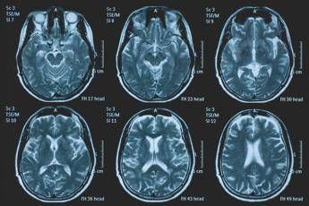 Una persona su 3 ha un disturbo neurologico, a Napoli arriva BrainSpace House
