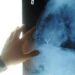 Radiologia interventistica, Ssn e fondazioni per cure più accessibili