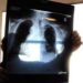 Sirm: “Ai strumento anti liste d’attesa, 50% esami imaging per over70 non necessario”