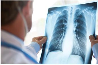 Cancro al polmone, approvato il rimborso di 2 nuove indicazioni per durvalumab
