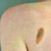 Imi: “Bene legge su prevenzione melanoma, educare i giovani su rischi”
