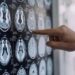 Malattia di Parkinson, ok in Europa a formulazione orale Ld/Cd a rilascio modificato